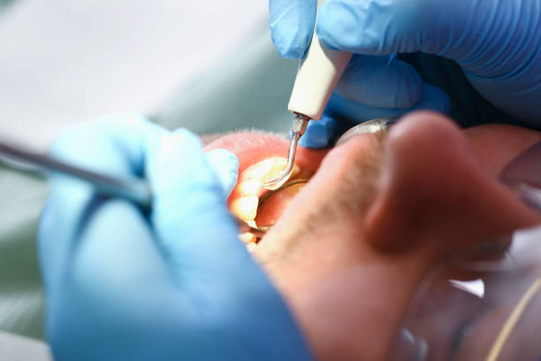 Best Emergency Tooth Extraction in Southern Shops, SC